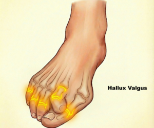 halluxvalgus
